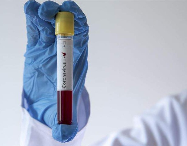 KCUS: Na koronavirus testirano 135 uzoraka, 13 pozitivnih